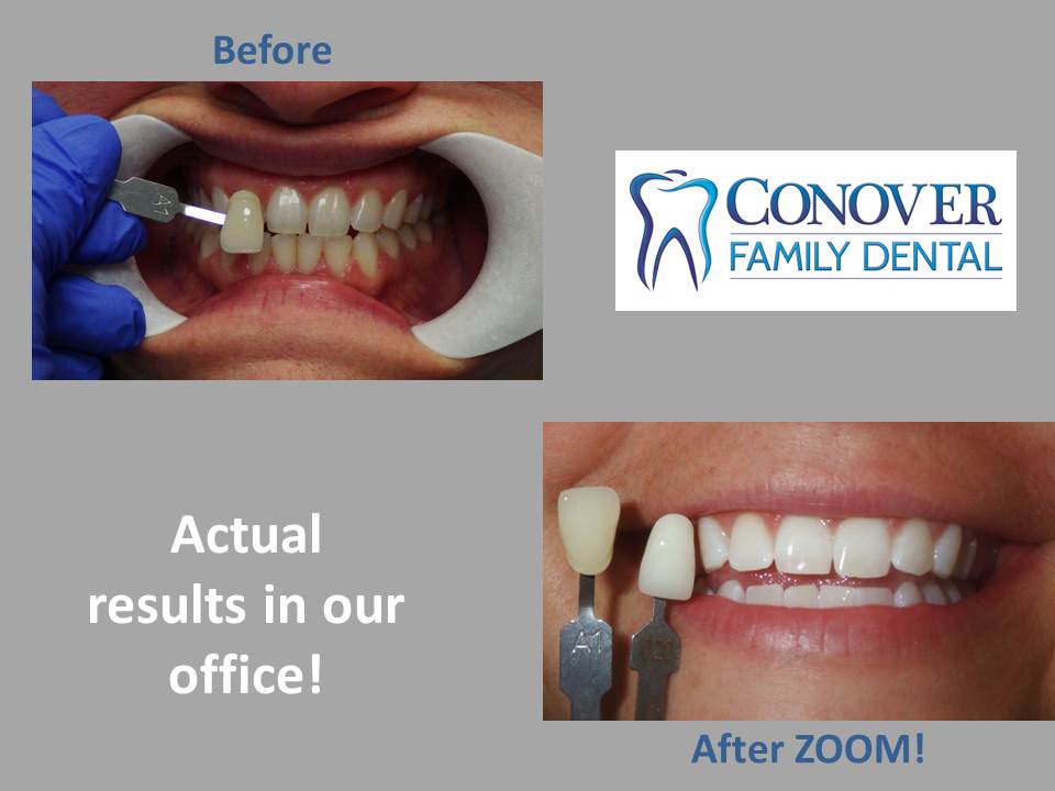 yellow teeth after zoom whitening